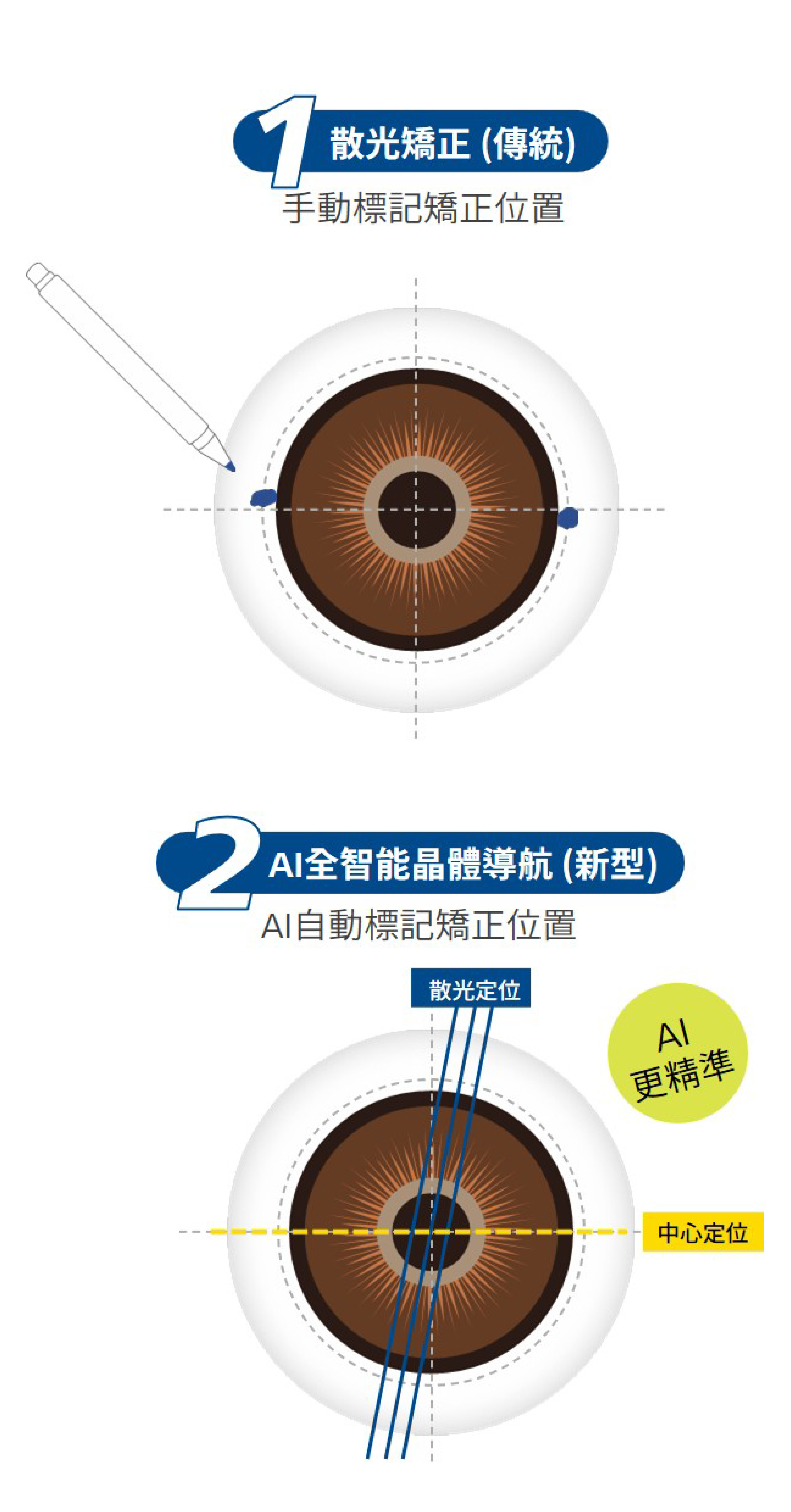 散光矯正 (傳統)。手動標記矯正位置。AI全智能晶體導航 (新型)。AI自動標記矯正位置。AI 更精準。散光定位。中心定位。