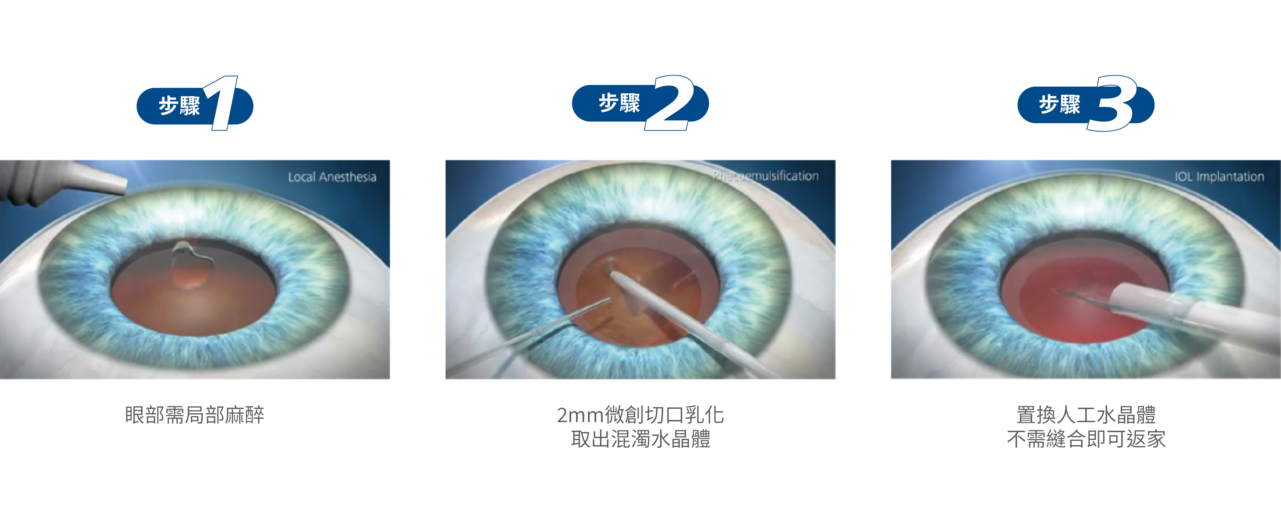 眼部需局部麻醉。2mm微創切口乳化取出混濁水晶體。置換人工水晶體不需縫合即可返家。