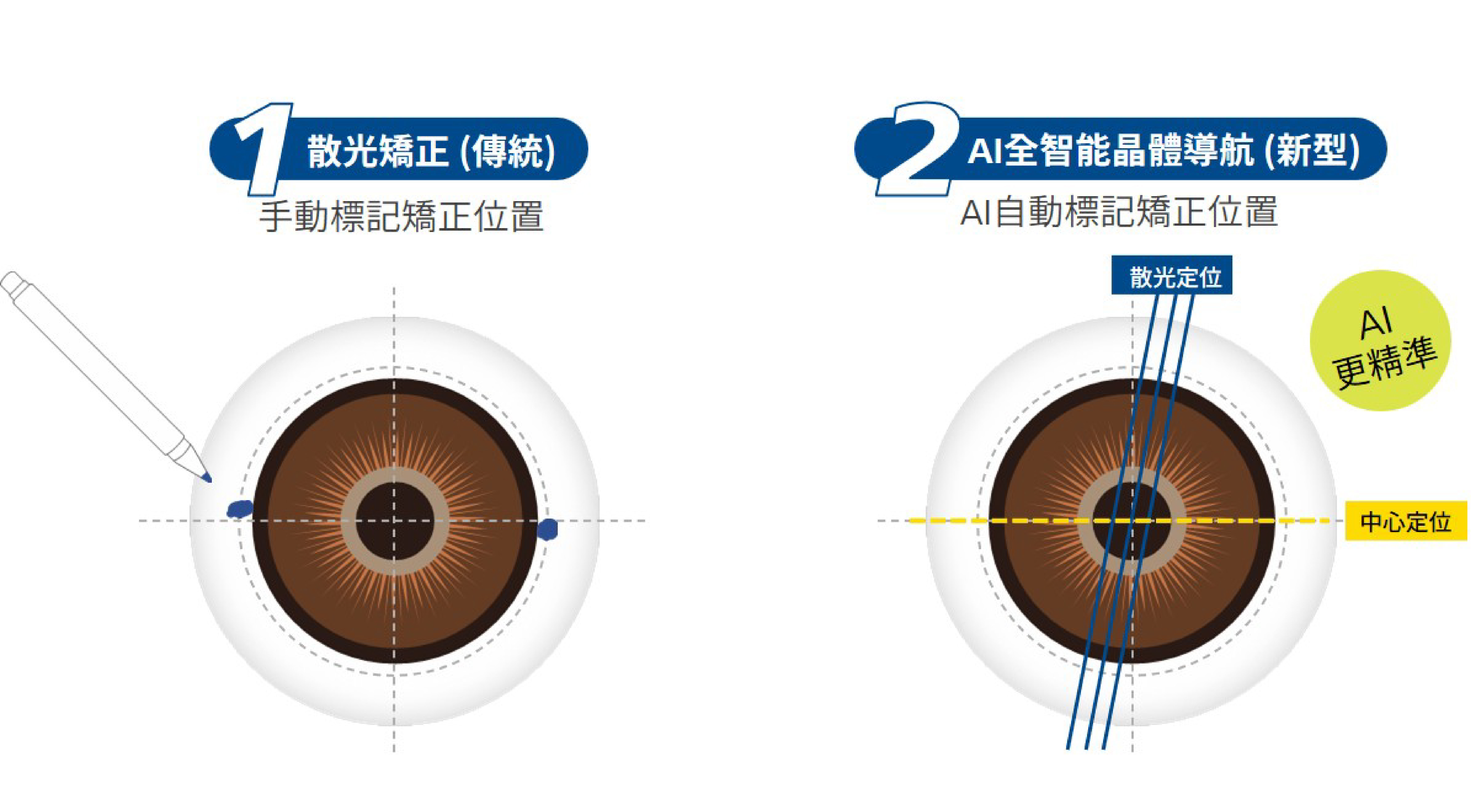 散光矯正 (傳統)。手動標記矯正位置。AI全智能晶體導航 (新型)。AI自動標記矯正位置。AI 更精準。散光定位。中心定位。