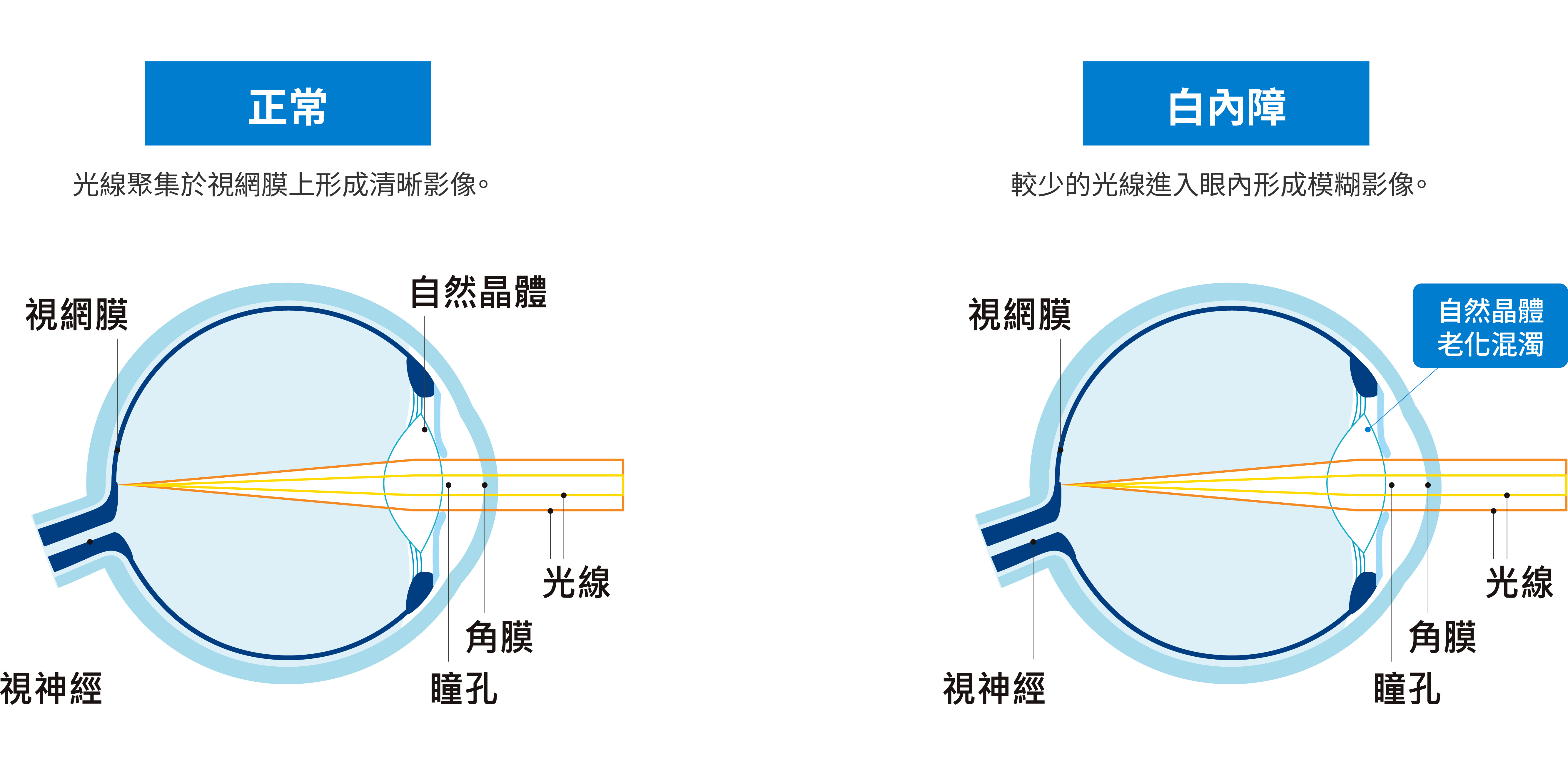 正常狀態與白內障比較。正常狀態光線聚集於視網膜上形成清晰影像。白內障狀態較少的光線進入眼內形成模糊影像。