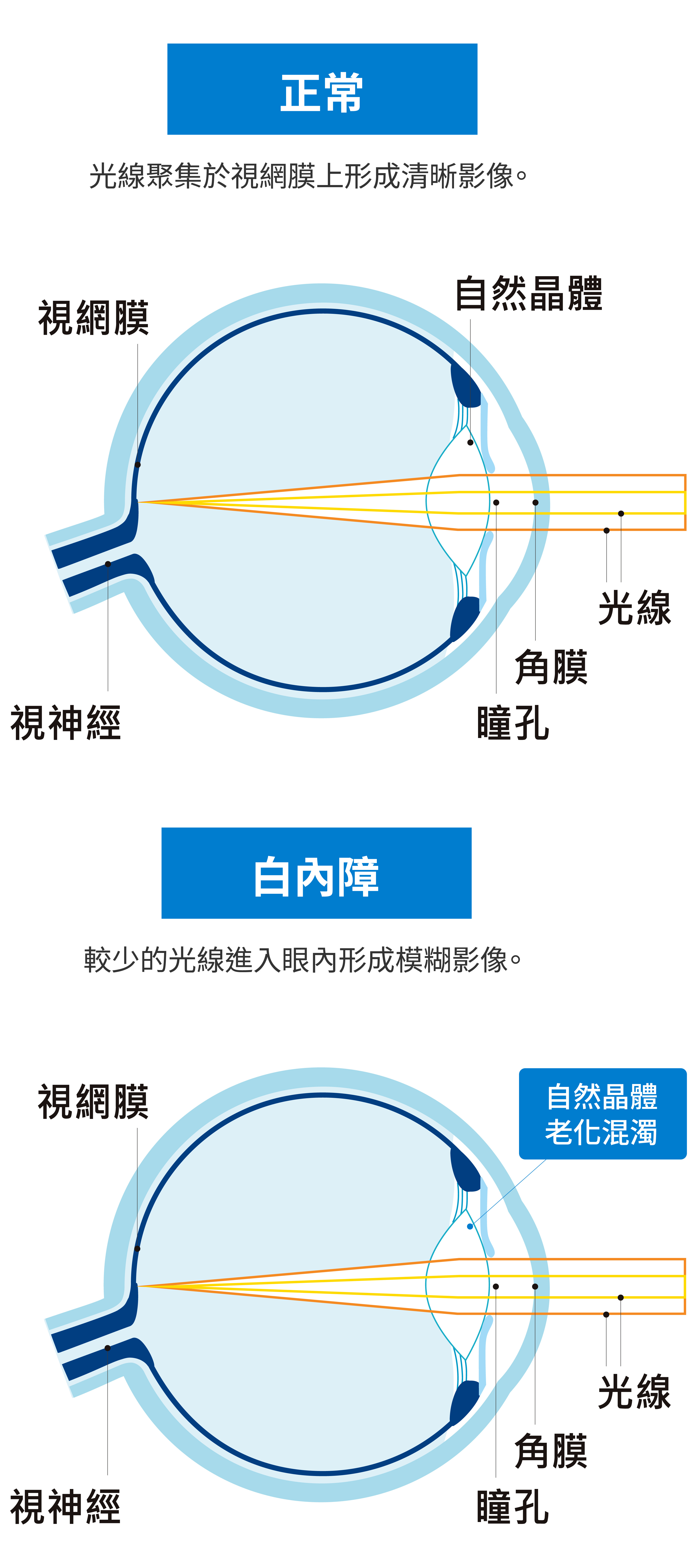 正常狀態與白內障比較。正常狀態光線聚集於視網膜上形成清晰影像。白內障狀態較少的光線進入眼內形成模糊影像。